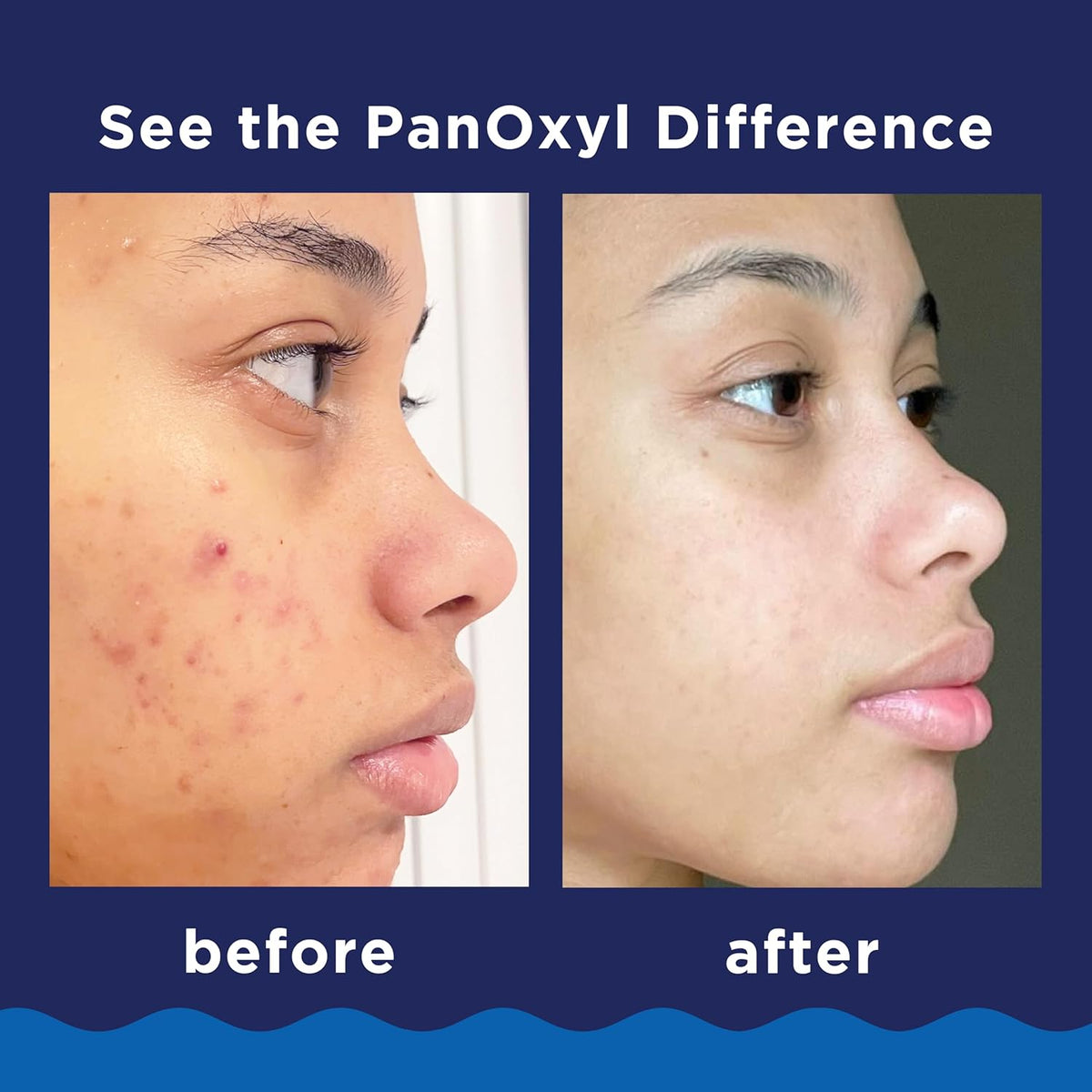 PanOxyl Acne Foaming Wash, 10% Benzoyl Peroxide, For Face & Body, 5.5 oz