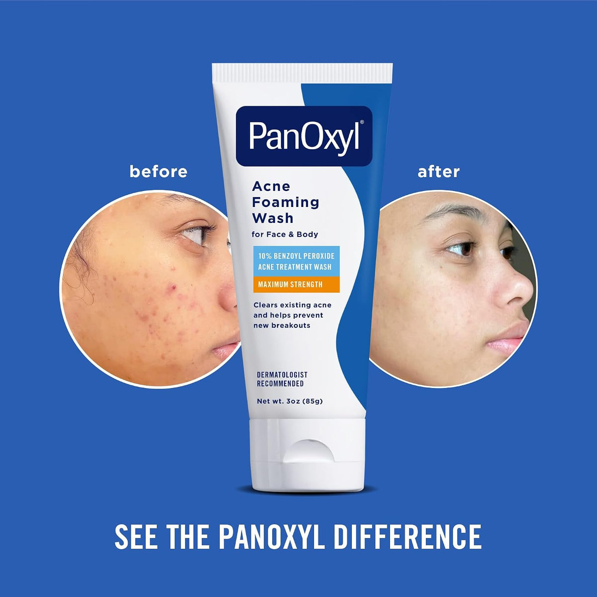 PanOxyl Acne Foaming Wash, 10% Benzoyl Peroxide, For Face & Body, 5.5 oz